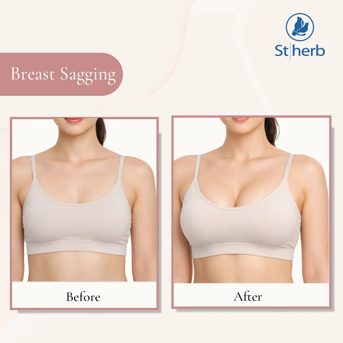 Before and after results of natural breast sagging treatment without surgery